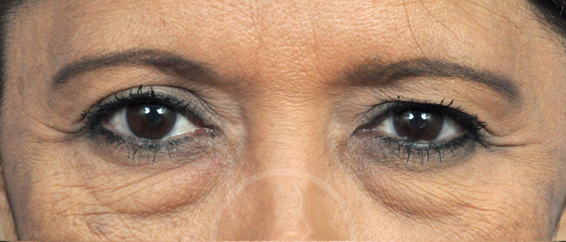 Blepharoplasty Before and After Pictures Jacksonville, FL