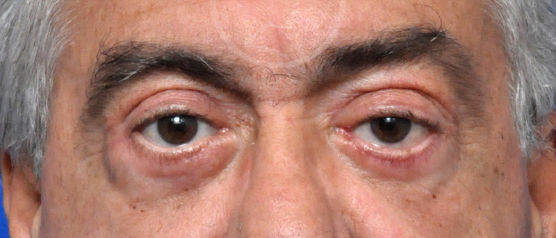 Blepharoplasty Before and After Pictures Jacksonville, FL