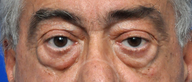 Blepharoplasty Before and After Pictures Jacksonville, FL