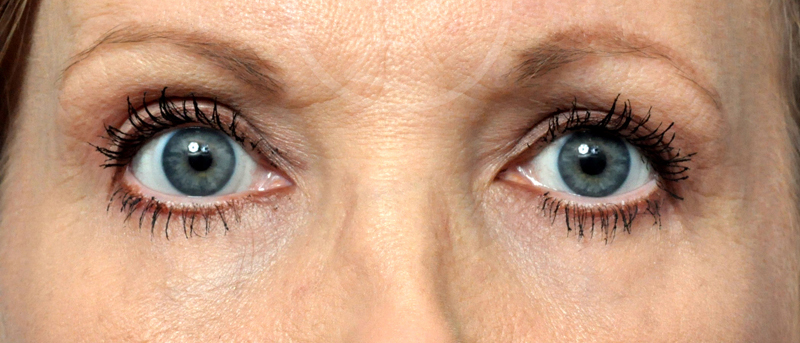 Blepharoplasty Before and After Pictures Jacksonville, FL