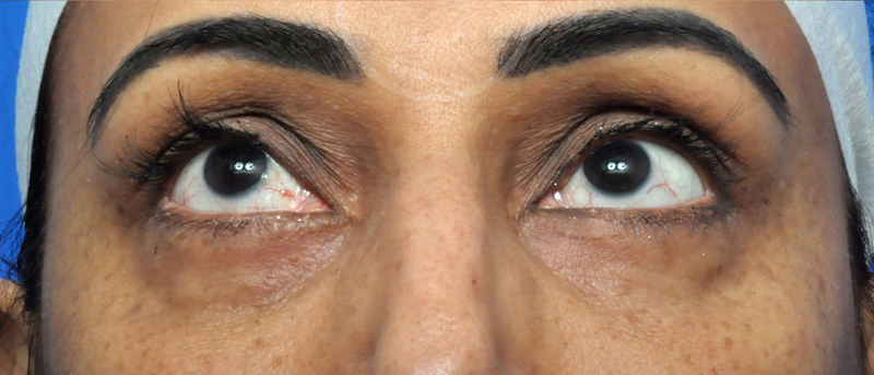 Blepharoplasty Before and After Pictures Jacksonville, FL