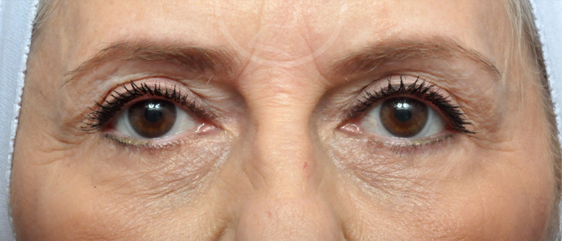 Blepharoplasty Before and After Pictures Jacksonville, FL