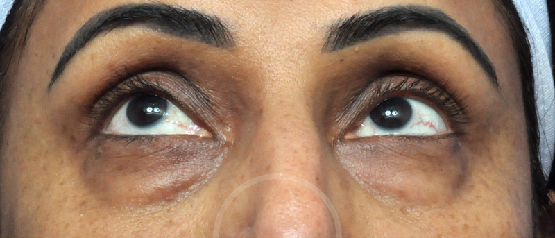 Blepharoplasty Before and After Pictures Jacksonville, FL