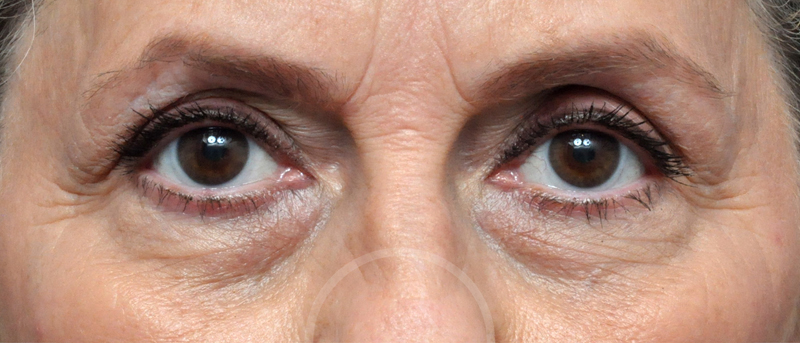 Blepharoplasty Before and After Pictures Jacksonville, FL