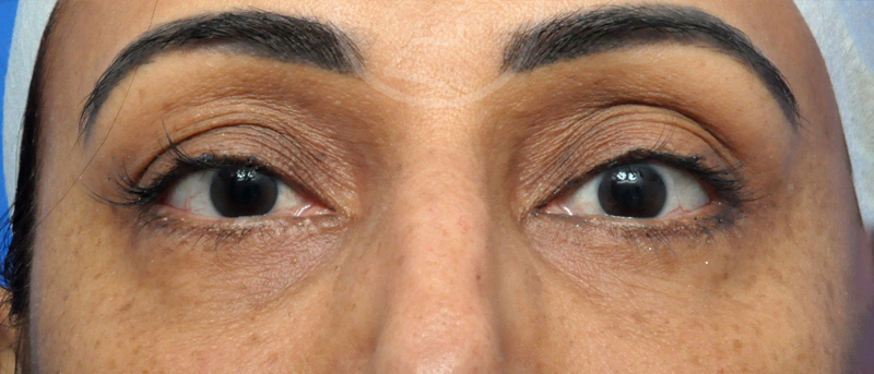 Blepharoplasty Before and After Pictures Jacksonville, FL