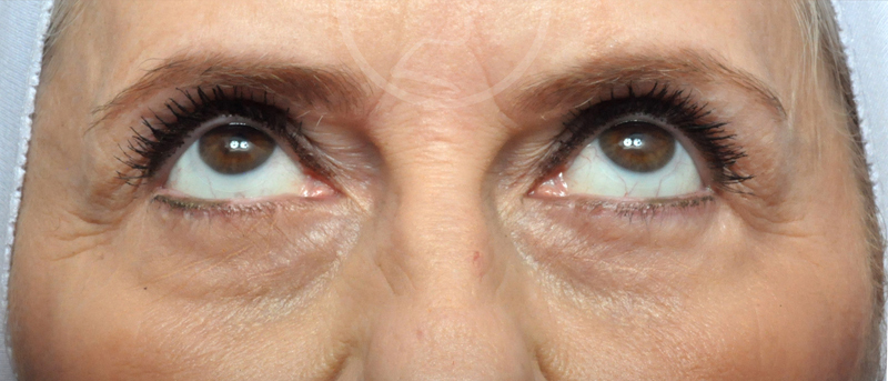 Blepharoplasty Before and After Pictures Jacksonville, FL