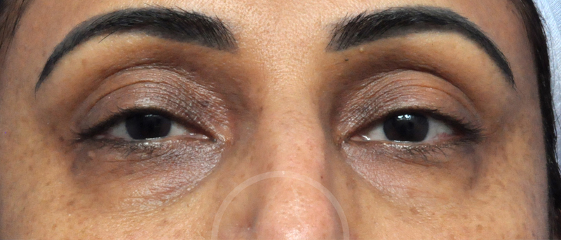 Blepharoplasty Before and After Pictures Jacksonville, FL