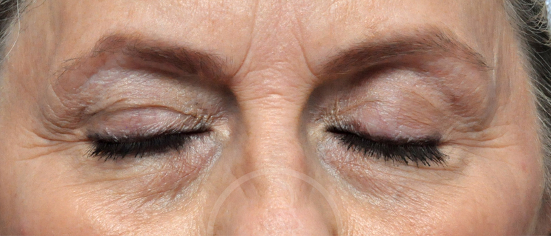 Blepharoplasty Before and After Pictures Jacksonville, FL