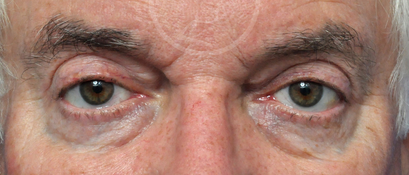 Blepharoplasty Before and After Pictures Jacksonville, FL