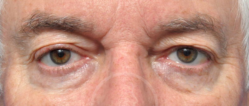 Blepharoplasty Before and After Pictures Jacksonville, FL