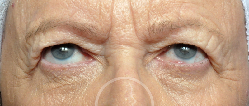 Blepharoplasty Before and After Pictures Jacksonville, FL