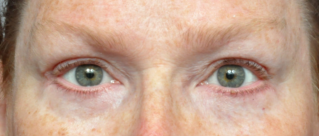 Blepharoplasty Before and After Pictures Jacksonville, FL