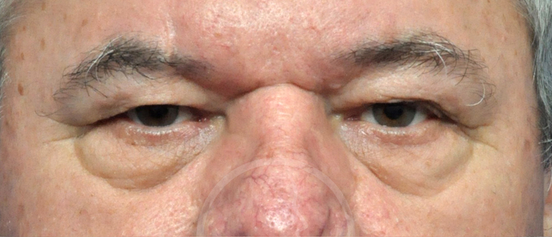 Blepharoplasty Before and After Pictures Jacksonville, FL