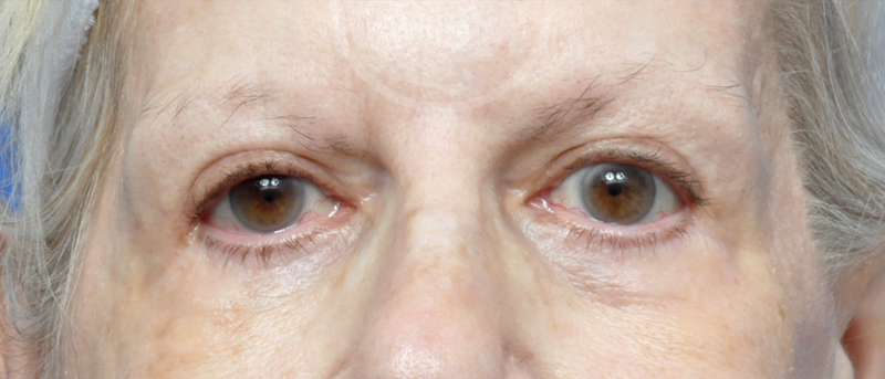 Blepharoplasty Before and After Pictures Jacksonville, FL