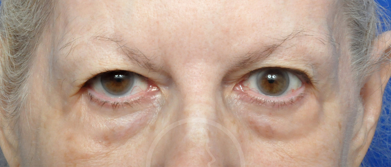 Blepharoplasty Before and After Pictures Jacksonville, FL