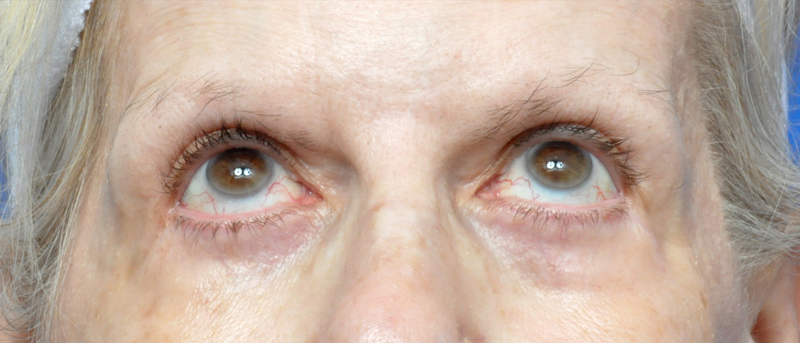 Blepharoplasty Before and After Pictures Jacksonville, FL