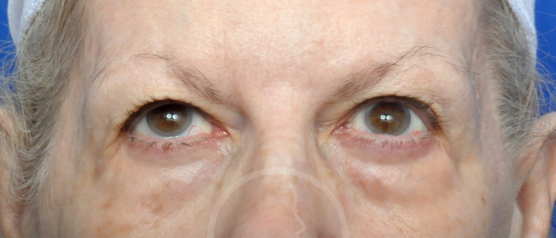 Blepharoplasty Before and After Pictures Jacksonville, FL