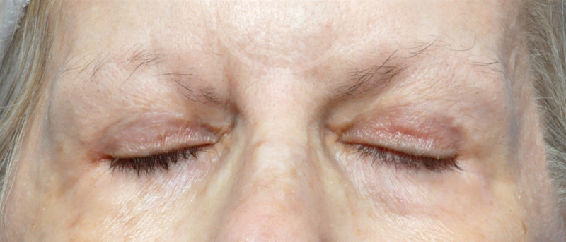 Blepharoplasty Before and After Pictures Jacksonville, FL