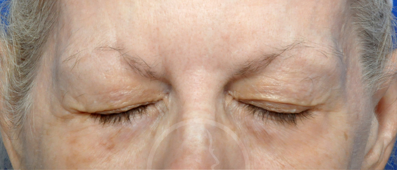 Blepharoplasty Before and After Pictures Jacksonville, FL