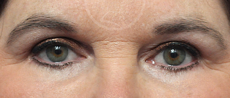 Blepharoplasty Before and After Pictures Jacksonville, FL