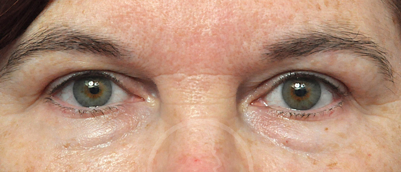 Blepharoplasty Before and After Pictures Jacksonville, FL