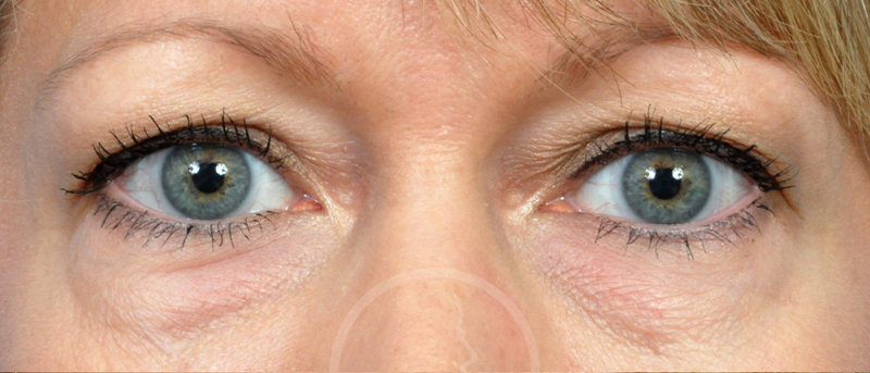 Blepharoplasty Before and After Pictures Jacksonville, FL