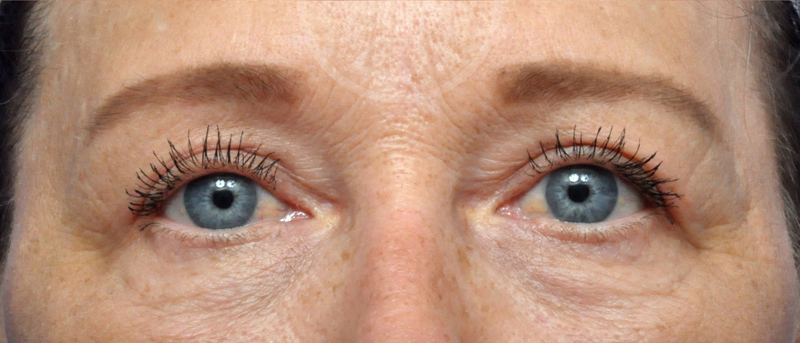 Blepharoplasty Before and After Pictures Jacksonville, FL