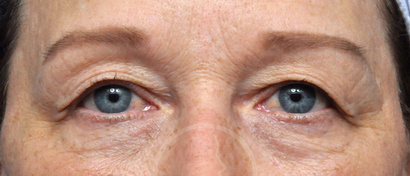 Blepharoplasty Before and After Pictures Jacksonville, FL