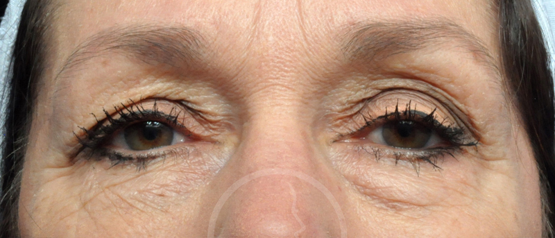 Blepharoplasty Before and After Pictures Jacksonville, FL