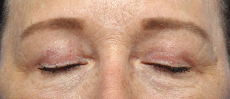 Blepharoplasty Before and After Pictures Jacksonville, FL