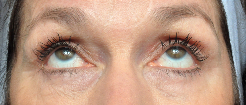 Blepharoplasty Before and After Pictures Jacksonville, FL