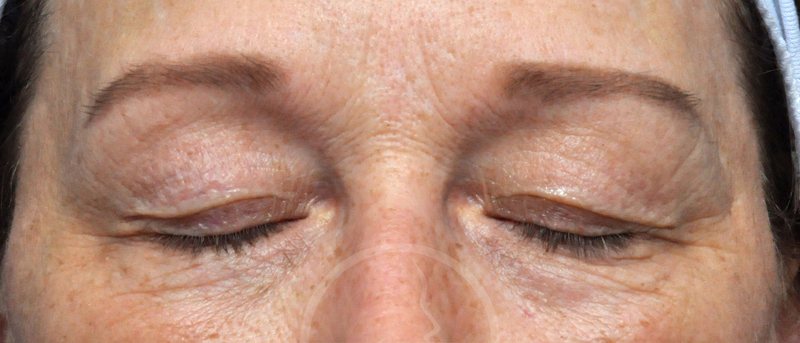 Blepharoplasty Before and After Pictures Jacksonville, FL