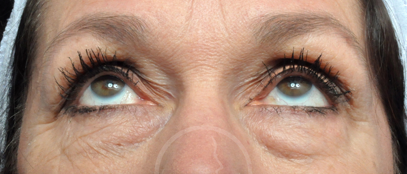 Blepharoplasty Before and After Pictures Jacksonville, FL