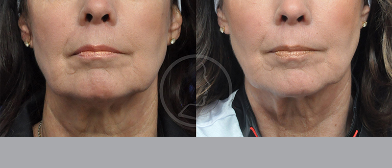 Blepharoplasty Before and After Pictures Jacksonville, FL