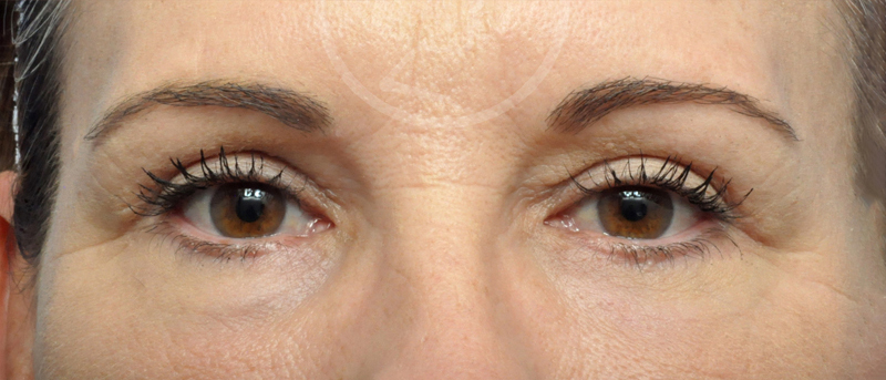 Blepharoplasty Before and After Pictures Jacksonville, FL