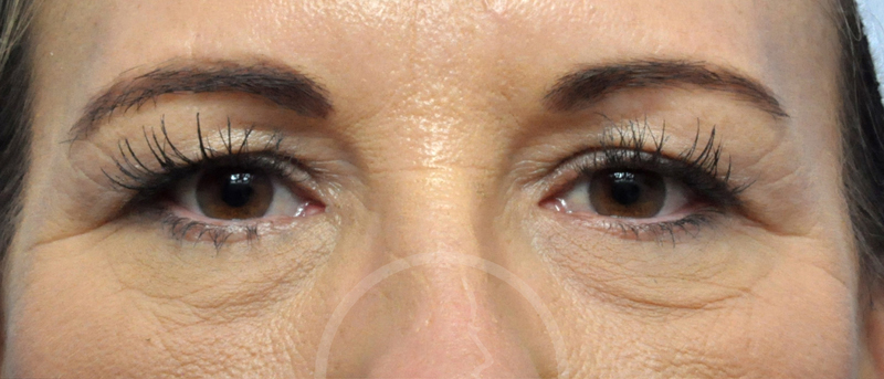 Blepharoplasty Before and After Pictures Jacksonville, FL