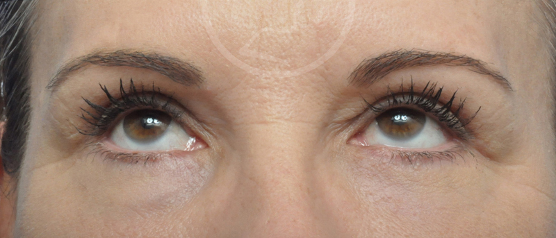 Blepharoplasty Before and After Pictures Jacksonville, FL