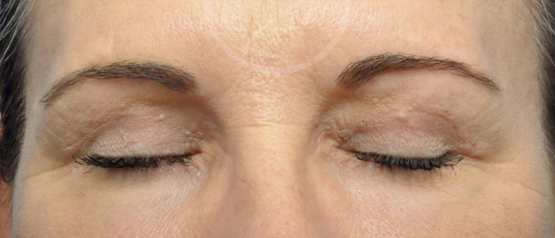 Blepharoplasty Before and After Pictures Jacksonville, FL