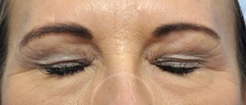 Blepharoplasty Before and After Pictures Jacksonville, FL