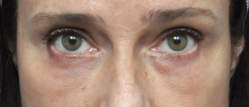 Blepharoplasty Before and After Pictures Jacksonville, FL