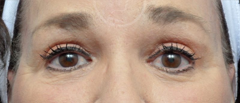 Blepharoplasty Before and After Pictures Jacksonville, FL