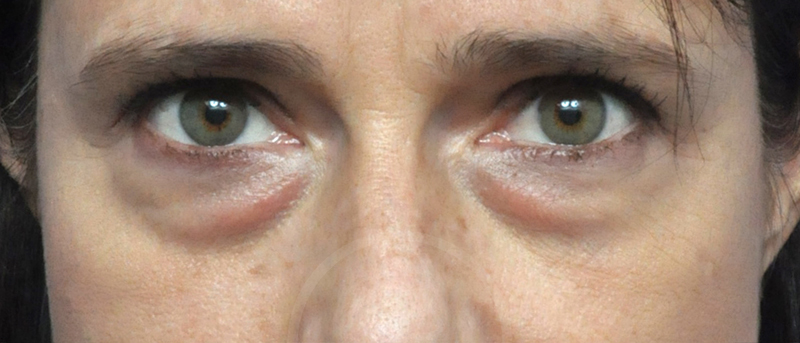 Blepharoplasty Before and After Pictures Jacksonville, FL