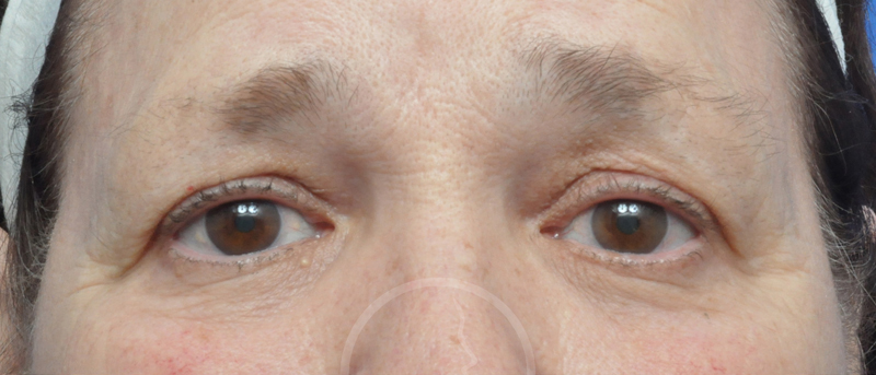 Blepharoplasty Before and After Pictures Jacksonville, FL