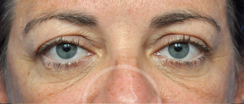 Blepharoplasty Before and After Pictures Jacksonville, FL