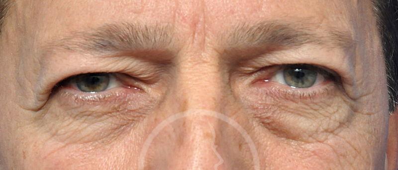 Blepharoplasty Before and After Pictures Jacksonville, FL