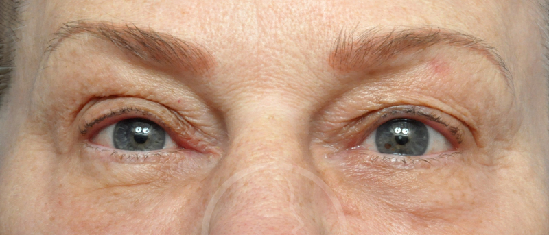 Blepharoplasty Before and After Pictures Jacksonville, FL