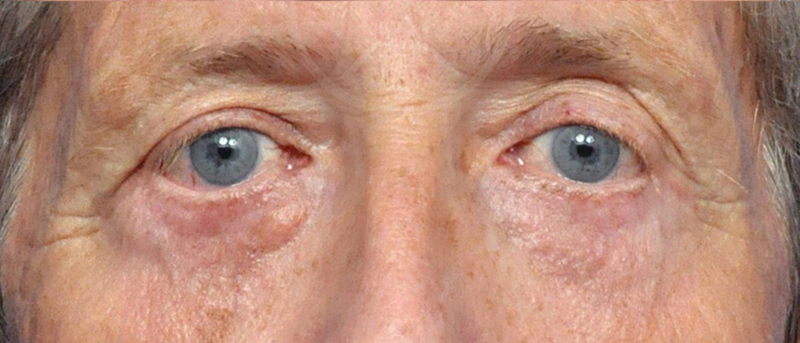 Blepharoplasty Before and After Pictures Jacksonville, FL