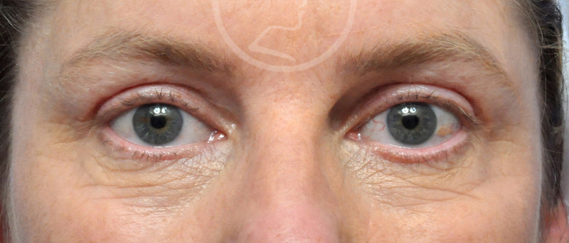 Blepharoplasty Before and After Pictures Jacksonville, FL