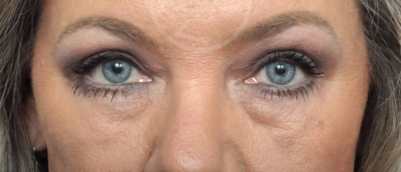 Blepharoplasty Before and After Pictures Jacksonville, FL