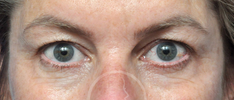 Blepharoplasty Before and After Pictures Jacksonville, FL